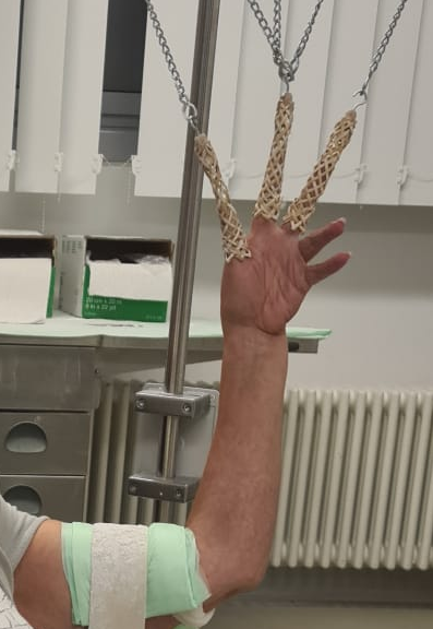 Anette Klassens linke Hand in einer Streckschiene nach dem Trümmerbruch, der Arm ist bandagiert.