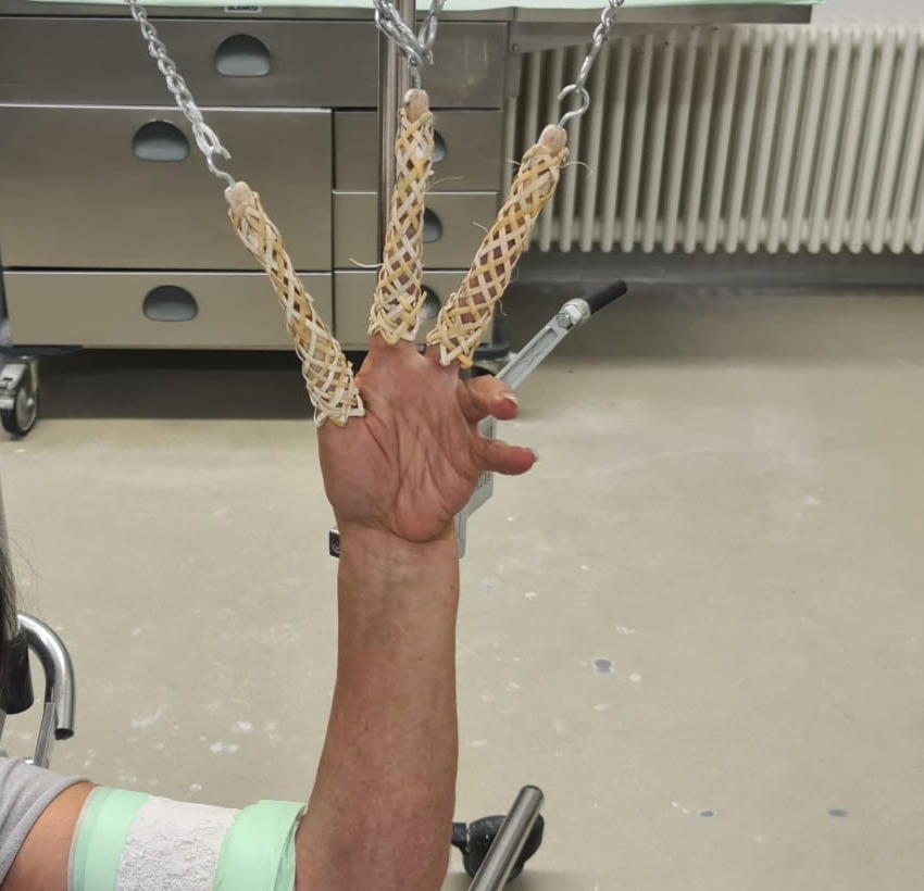 Anette Klassens Hand nach dem Einsatz in ärztlicher Behandlung.